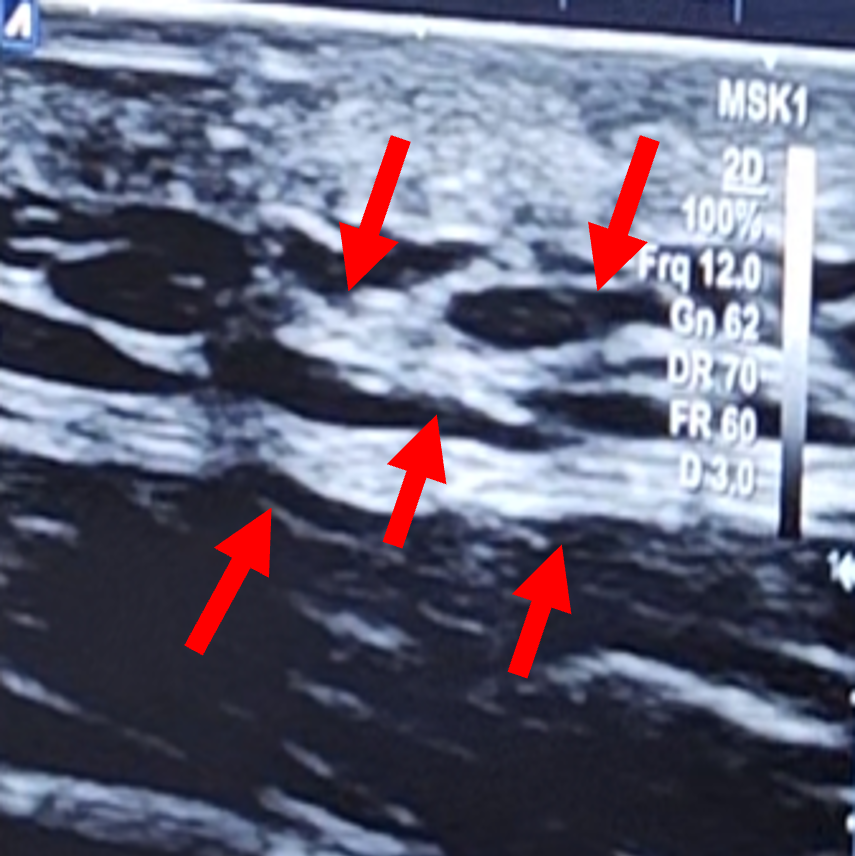 Before ultrasound image