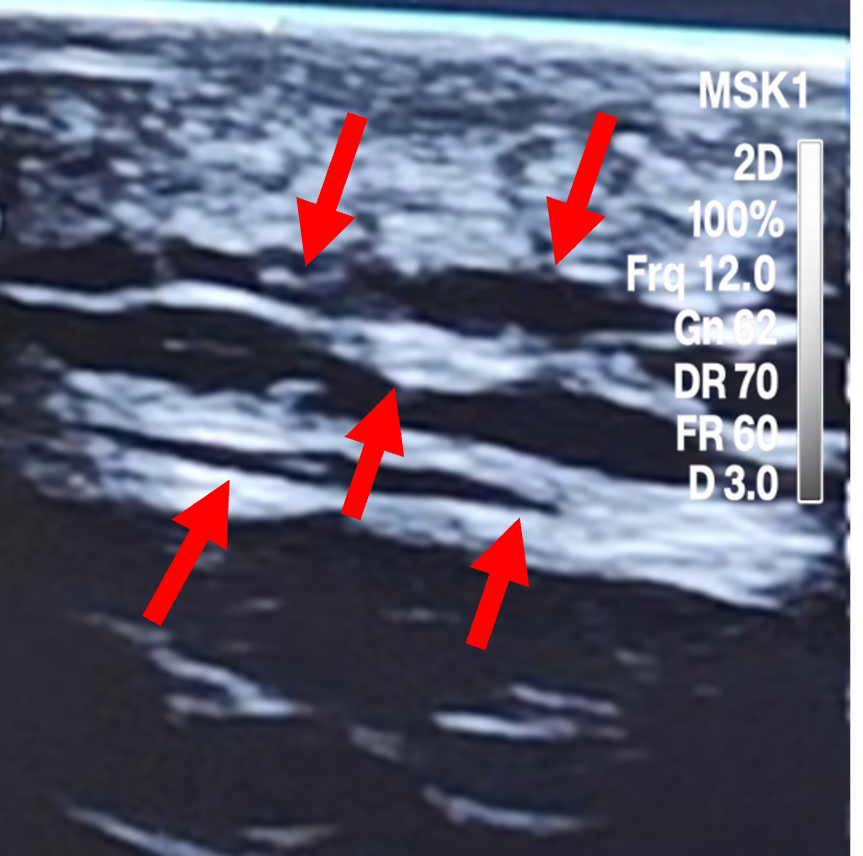 After ultrasound image